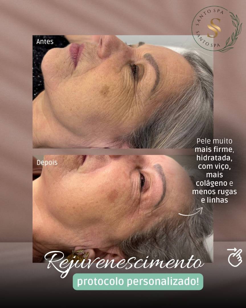 Resultado de tratamento 5